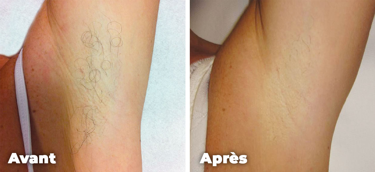 Epilation-laser-femme-aisselles-avant-apres