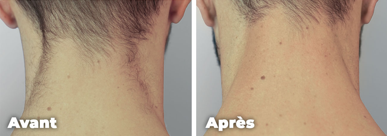 Epilation-laser-homme-cou-arriere-avant-apres