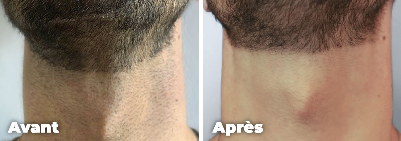Epilation-laser-homme-cou-avant-apres