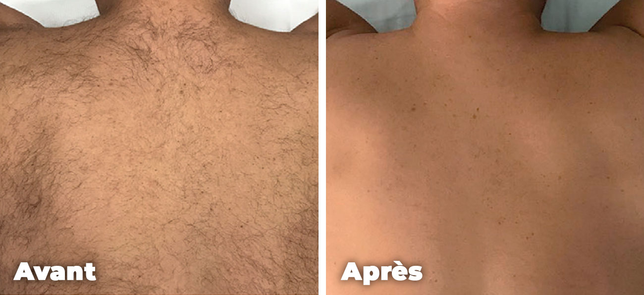 Epilation-laser-hommes-dos-avant-apres